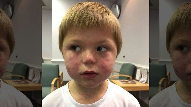 Georgia mom warns others after son contracts rare disease from tick bite