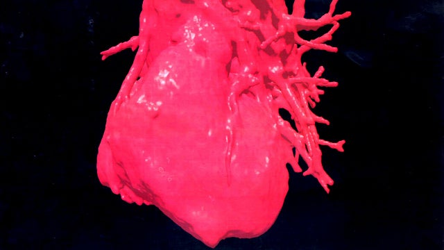 World's first 3D printed heart unveiled by researchers in Israel