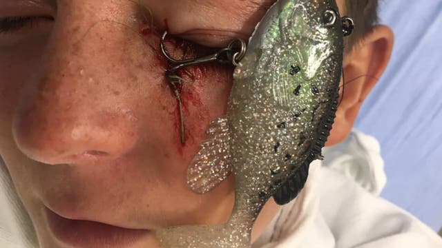 Fishing accident leaves 11-year-old with hook in his eyelid
