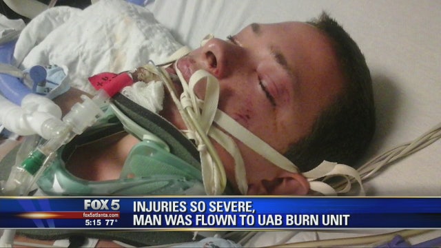 Exclusive: Man Severely Injured After eCigarette Blows Up In His Face