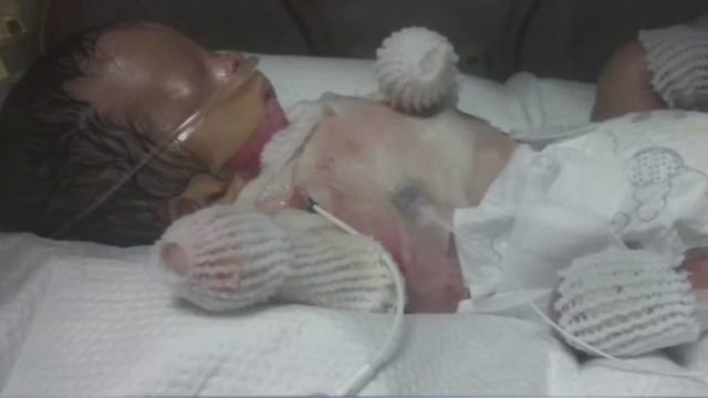 Doctors say promising news for baby born without skin