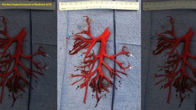 Man coughs up blood clot shaped like lung's bronchial tree