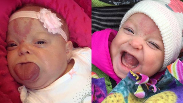 Baby with genetic syndrome smiling after tongue-reduction surgery