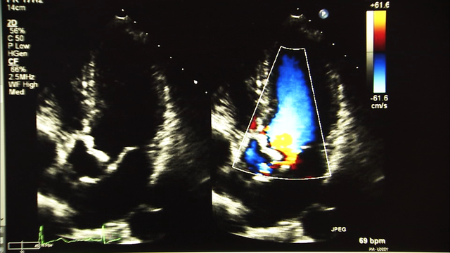 Heart surgeon discusses options for patients with severe heart failure
