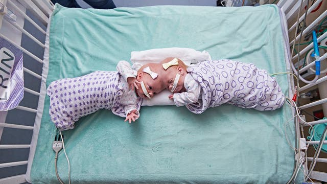 Formerly conjoined twins thriving months after separation surgery