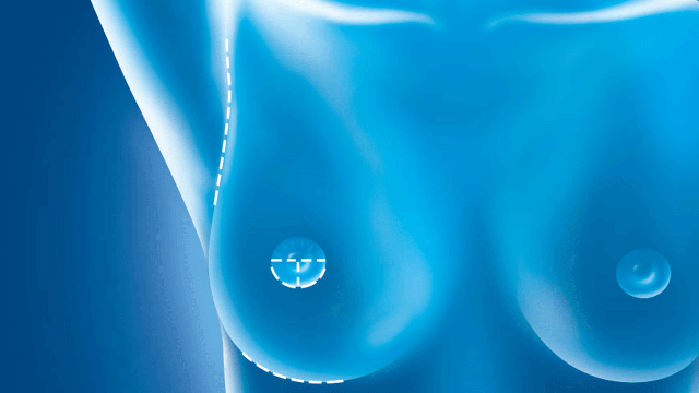 Allergan recalls textured breast implant tied to rare cancer