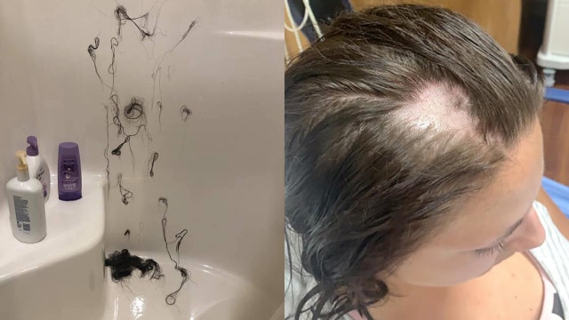 Woman loses hair 'in clumps' after Nair was allegedly mixed into conditioner bought at Walmart