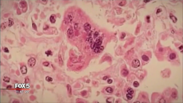 Medical experts say largest outbreak of mumps in 10 years