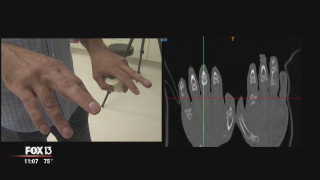 St. Pete doctor implants first 3-D printed bone into man's finger