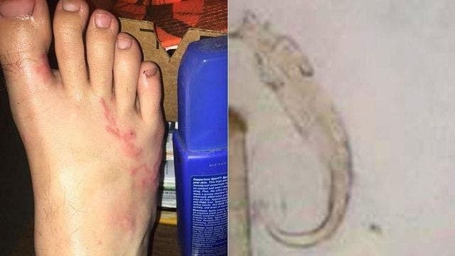 Teen contracts parasitic worm at beach