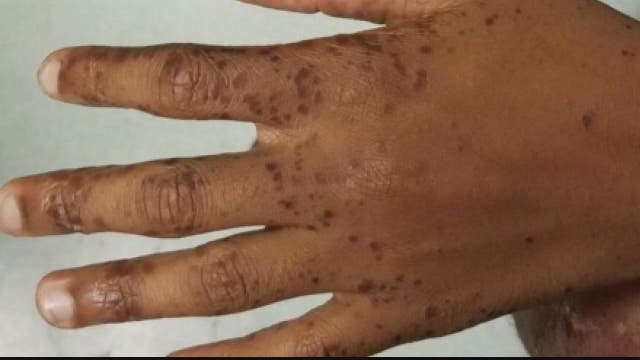 Doctors are seeing spike in hand, foot and mouth disease