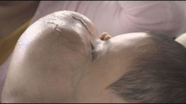 Cuban boy dies after surgery to remove 10-pound face tumor