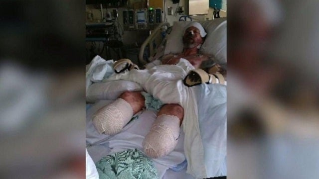 Man has 4 limbs amputated after dog lick leads to severe infection
