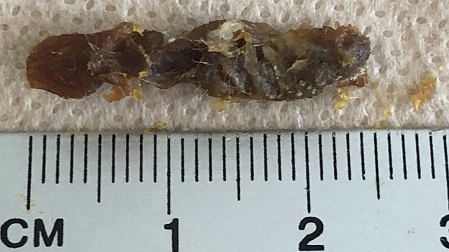 Earwax clump clogging entire ear canal removed from patient: 'Look at that!'
