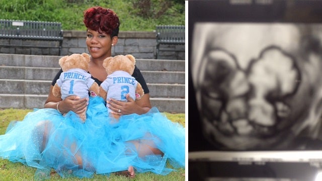 Conjoined Twins Shown in Touching Sonogram