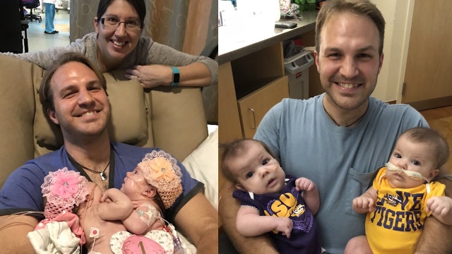 Conjoined twins return home after separation surgery