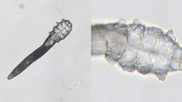 Face mites feast on skin oils, mate while you sleep