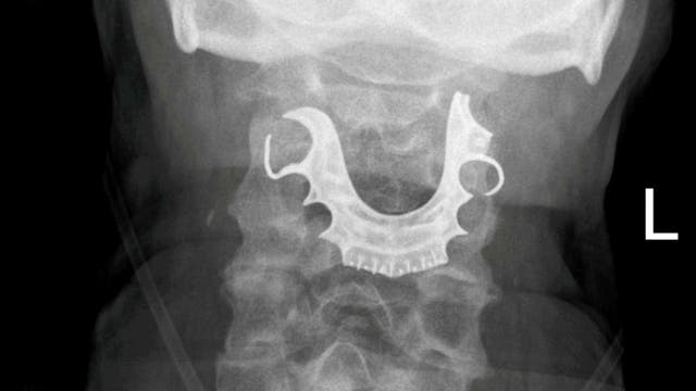 Man undergoes emergency surgery after dentures found lodged in throat days after procedure