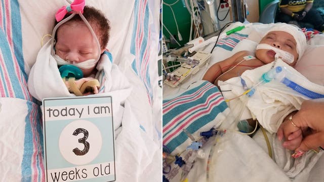 Miracle baby born with severe heart disease, taken off life support, about to celebrate 1st birthday