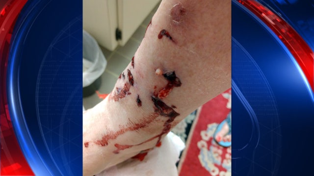 Citrus Park woman warns about raccoon after bloody attack