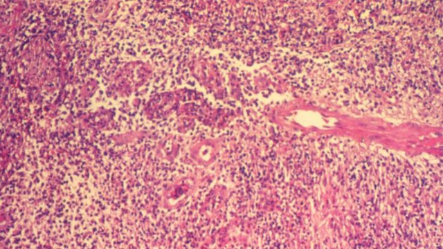 'Flesh-eating' STD allegedly making the rounds