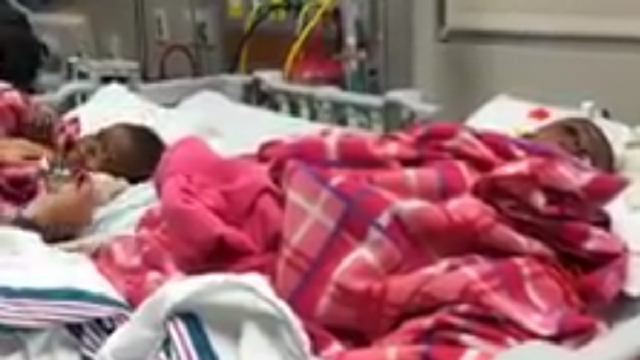 Conjoined twins from Nigeria separated at Tennessee hospital