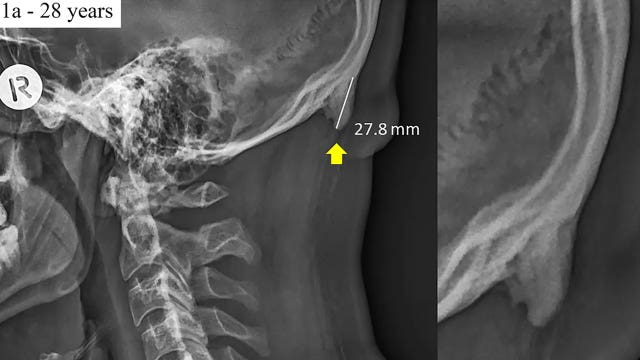 Larger bone spike at back of head in young adults possibly due to poor posture from tech, study says