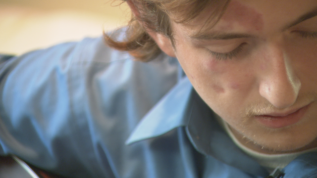 For men with Lupus, getting a diagnosis can take time