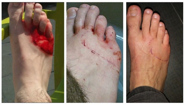 16a65ca9-Kody Stephens shark bite_1491693436267.jpg