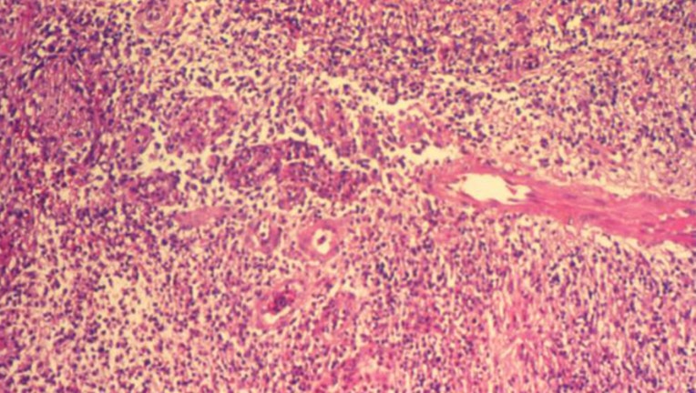 std 18898_lores Donovanosis_1534969184696.jpg-404023.jpg