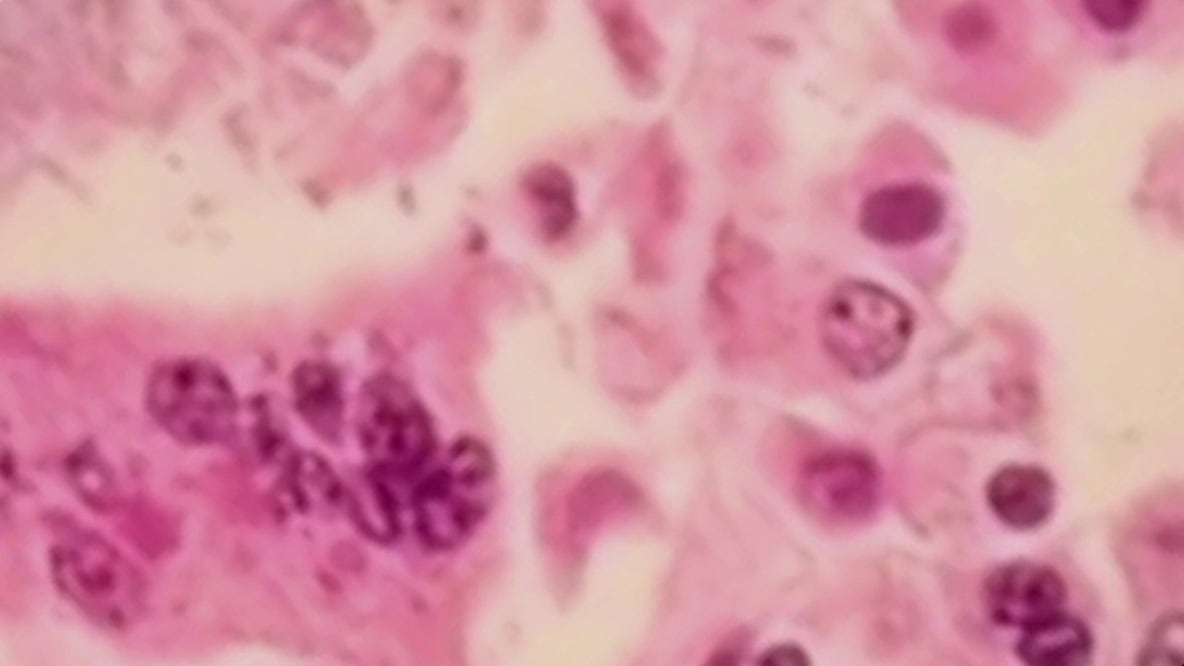 Measles hits metro Atlanta family: What you need to know about symptoms
