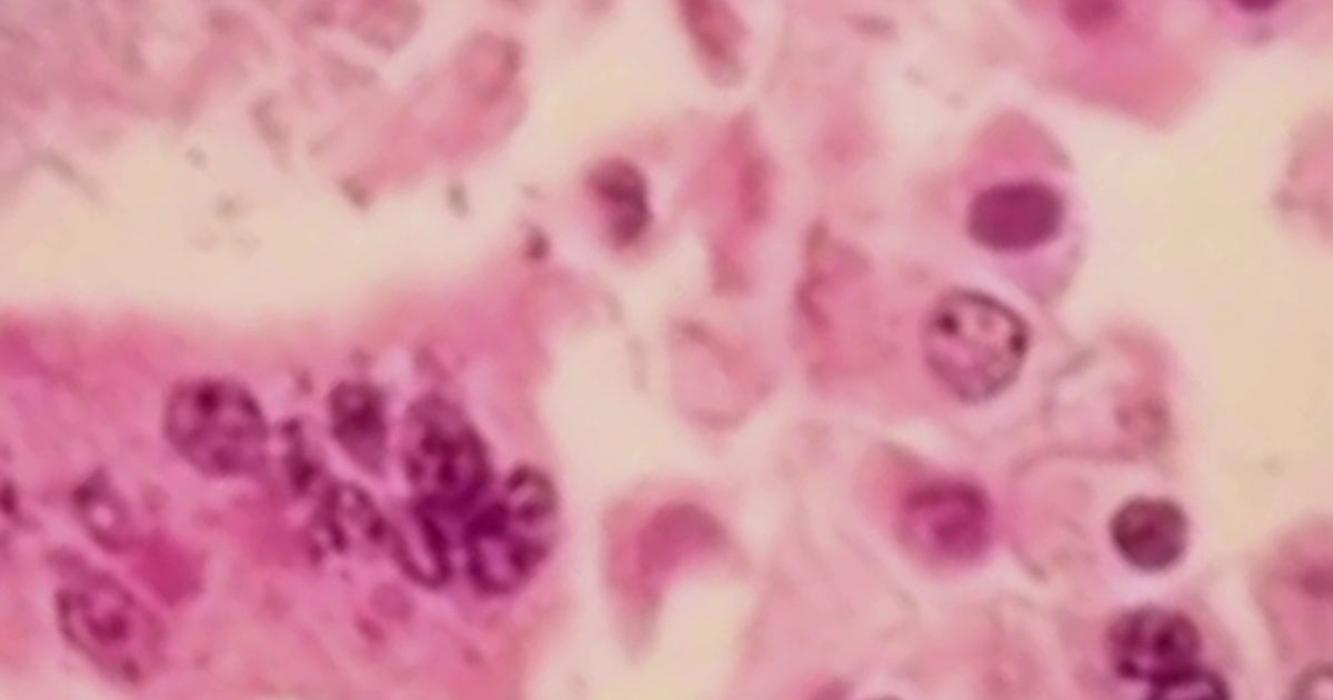 2.Measles hits metro Atlanta family: What you need to know about symptoms