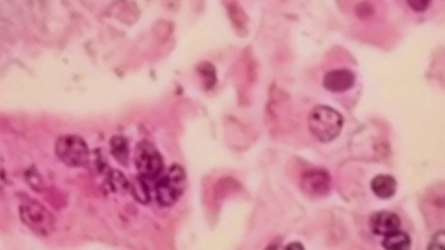 Georgia confirms three new measles cases linked to September outbreak