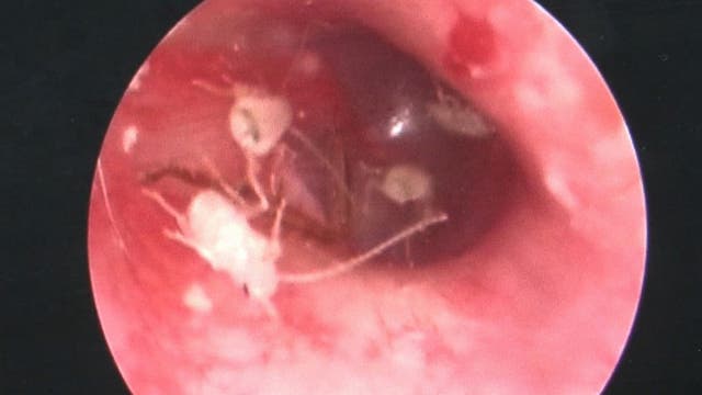 Man had family of cockroaches living inside ear canal, report says