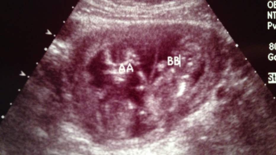 Ultrasound image of twins