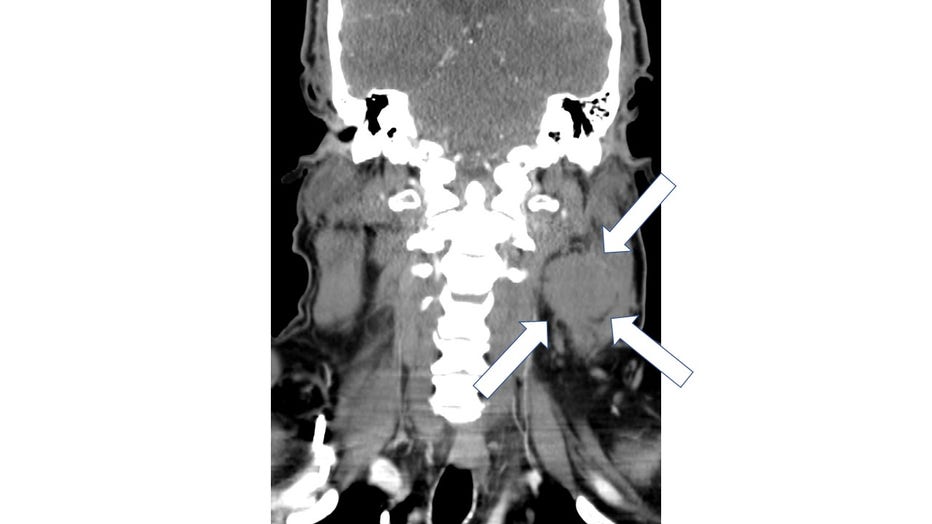 MRI scan of Erin Frank's neck mass