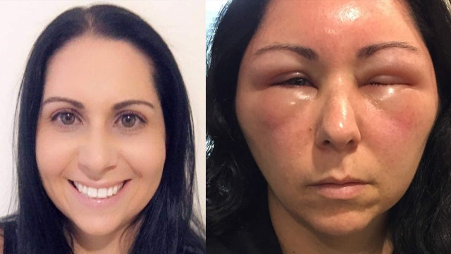 Woman's allergic reaction to hair dye causes severe swelling in face, head