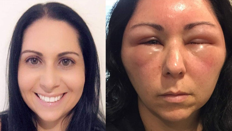 Woman S Allergic Reaction To Hair Dye Causes Severe Swelling In Face   Hair Dye Allergic Reaction 