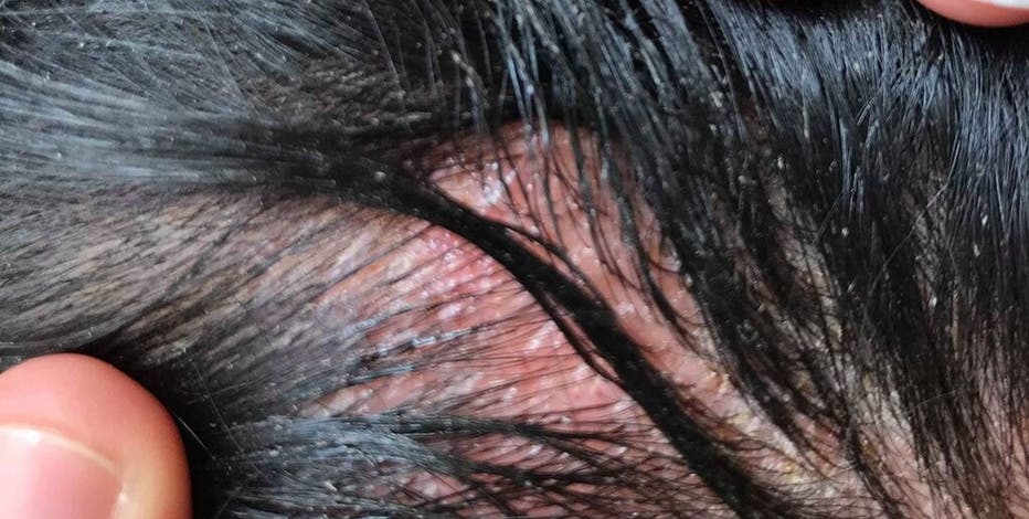 Woman's allergic reaction to hair dye causes severe swelling in face, head Woman's allergic reaction to hair dye causes severe swelling in face, head