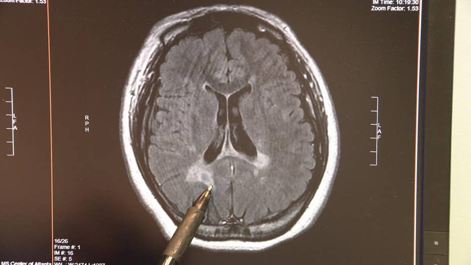 Brain scan shows two lesions typical with MS