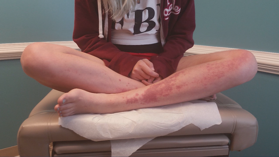 Patients fear shortage of Lupus drug used in treatment of coronavirus