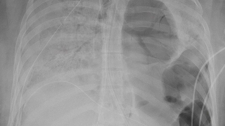 lung xray