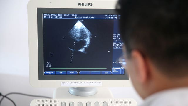More than half of COVID-19 patients scanned in study show heart abnormalities, researchers say