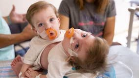 University of Michigan doctors separate 1-year-old conjoined twins in 11-hour surgery