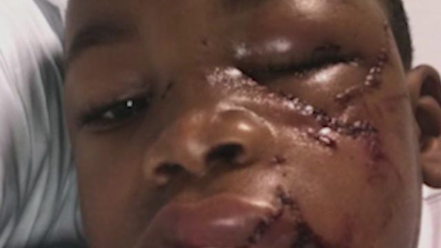 Boy suffers facial injuries in attack at Atlanta dog park