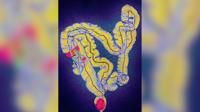 Colorectal cancer screening age lowered to 45 from 50