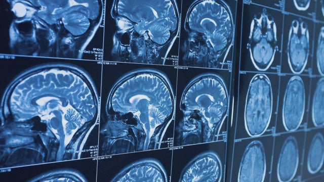 British researchers identify 75 genes that may raise the risk of Alzheimer's disease