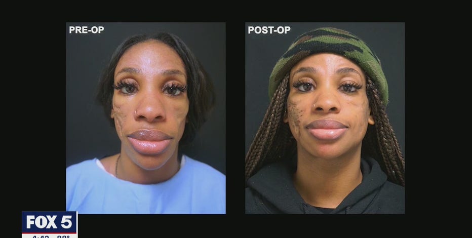 After Lupus changed her face, Atlanta woman turns to surgery for