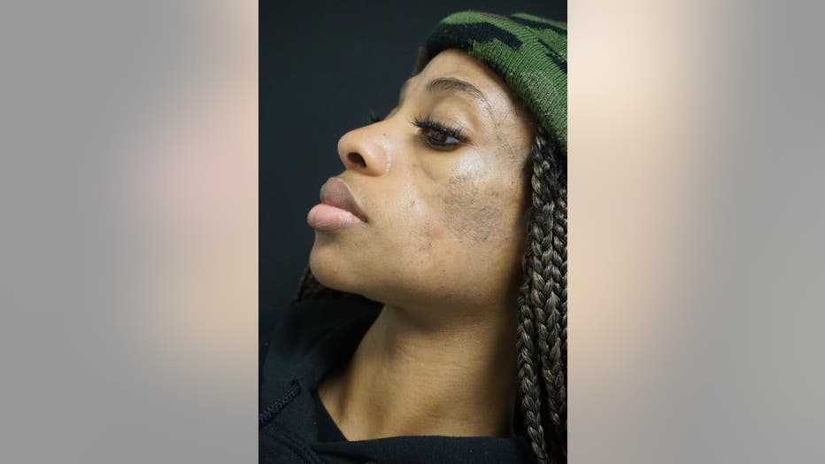 Profile of African American woman shows restored fullness in her face after a fat grafting procedure