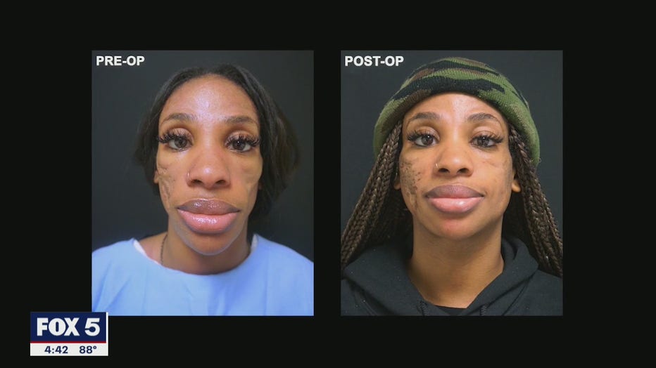 Before and after photos of an African American woman who underwent a surgical procedure to restore fullness to her face. In the first photo she is very thin. In the second, she has volume in her cheeks.